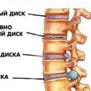 Кровать для вытяжки позвоночника .